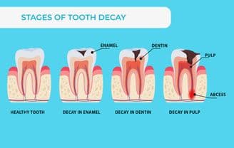 Study Suggests Combined Use of Fluoride and Iodine Is Significantly More Effective in Preventing Tooth Decay Then Fluoride Alone