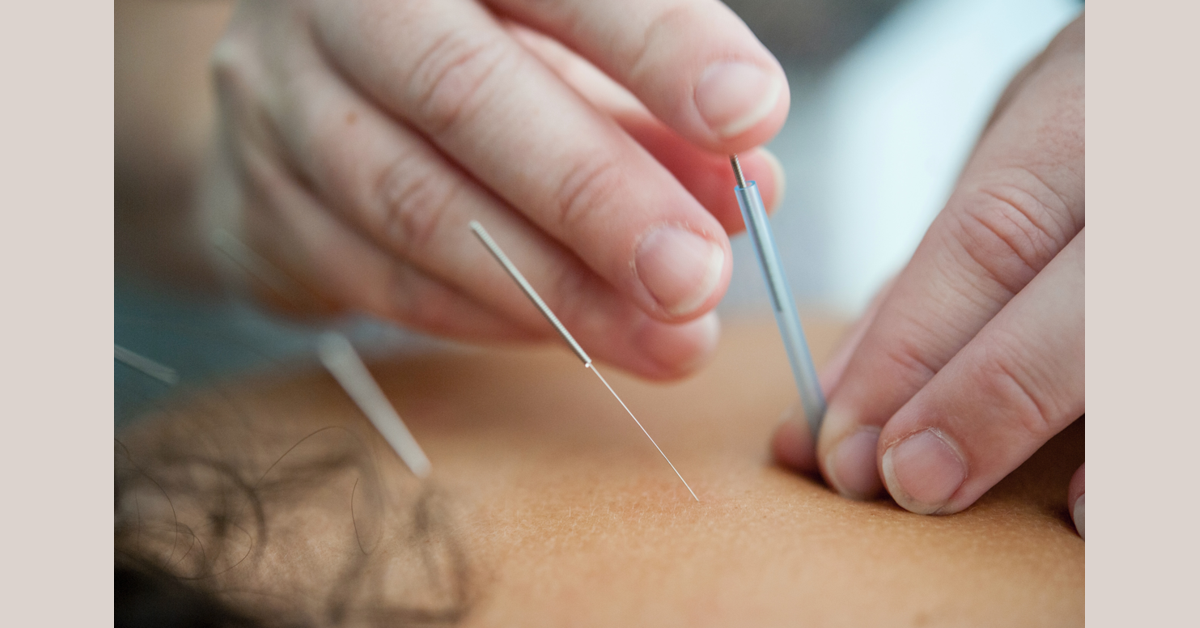 banner image for: La forma en que la acupuntura cura el cuerpo - una opción de tratamiento de Flourish Counseling.