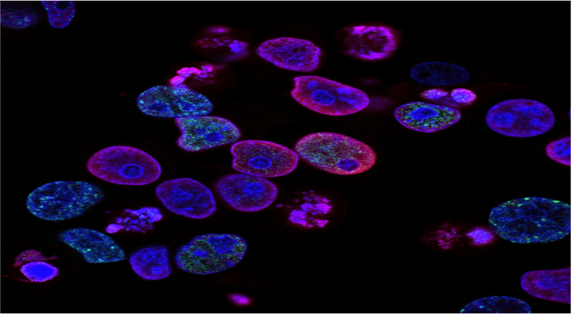 Groundbreaking Clinical Trial Offers New Hope for Advanced Prostate Cancer Patients