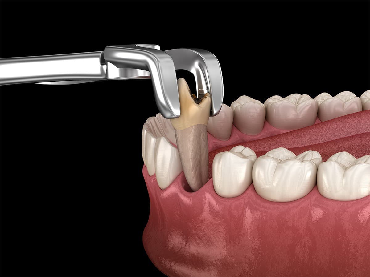 Sioux Falls Oral Surgery Practice Publishes Tooth Extraction Guide to Reduce Patient Anxiety