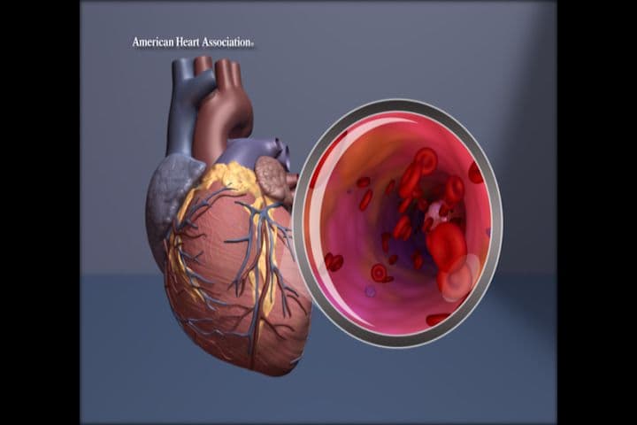 MESA Heart Disease Risk Score Proves Effective Without Race Factor