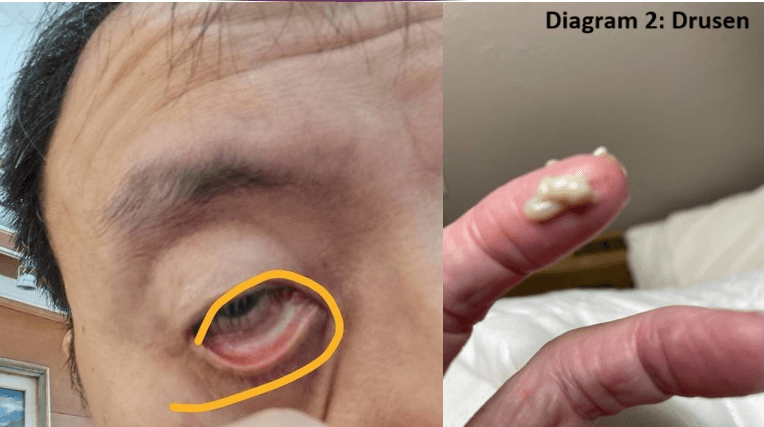 Lorati Unveils Nano-Grade Eye Drops for Age-Related Macular Degeneration Treatment